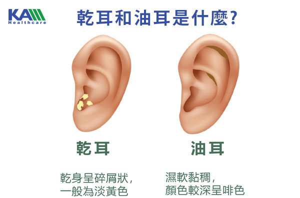 耳鼻喉科醫生專訪：點解耳仔「塞塞地」？為你解開傳導性聽障之謎3.jpg